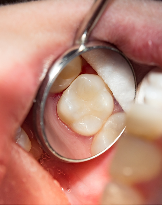 Using dental mirror to examine a tooth with a dental sealant