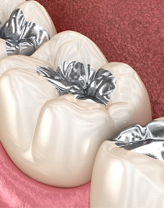 Illustration of teeth with silver diamine fluoride