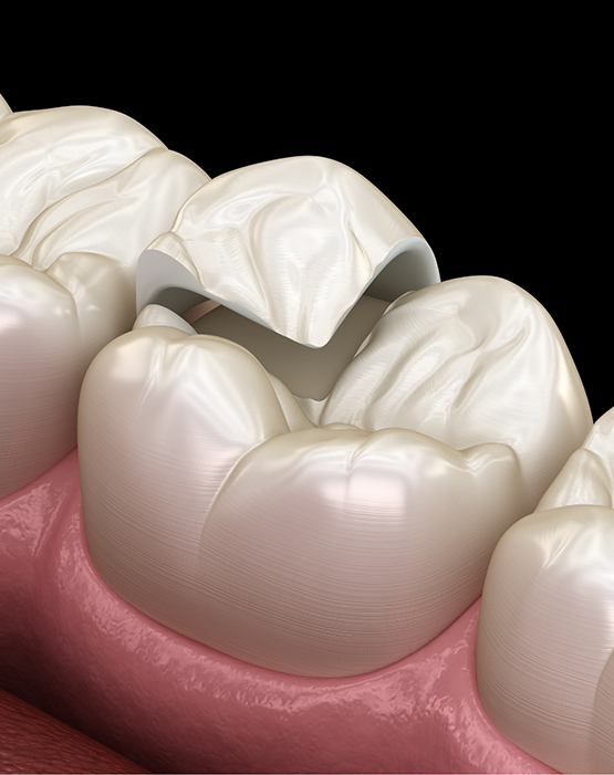 Metal free restoration being attached to a tooth
