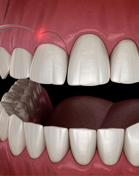Illustration of dental laser use for gum recontouring
