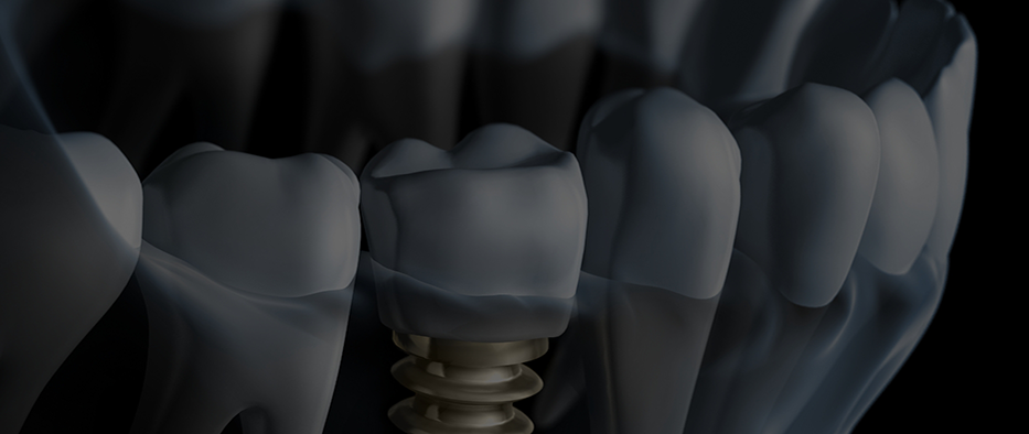 Illustration of a dental implant in the lower jaw