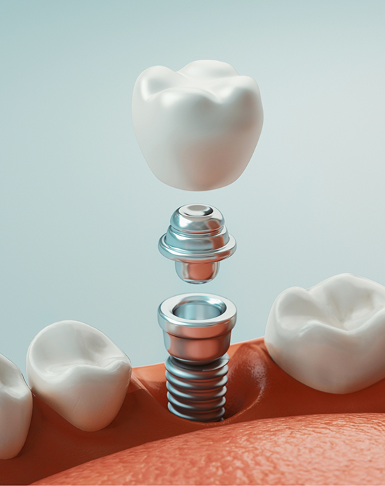 Illustration of dental crown and abutment being attached to a dental implant