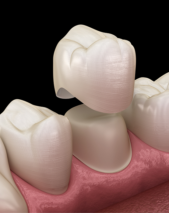 Illustration of a dental crown being attached to a tooth