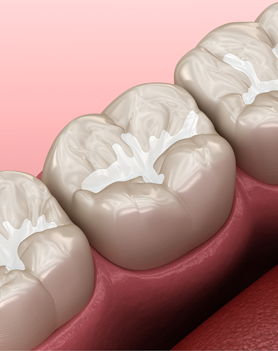 Illustration of a tooth with a white filling