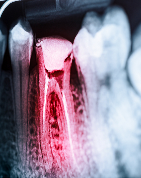 X-ray of teeth with tooth in need of root canal treatment highlighted