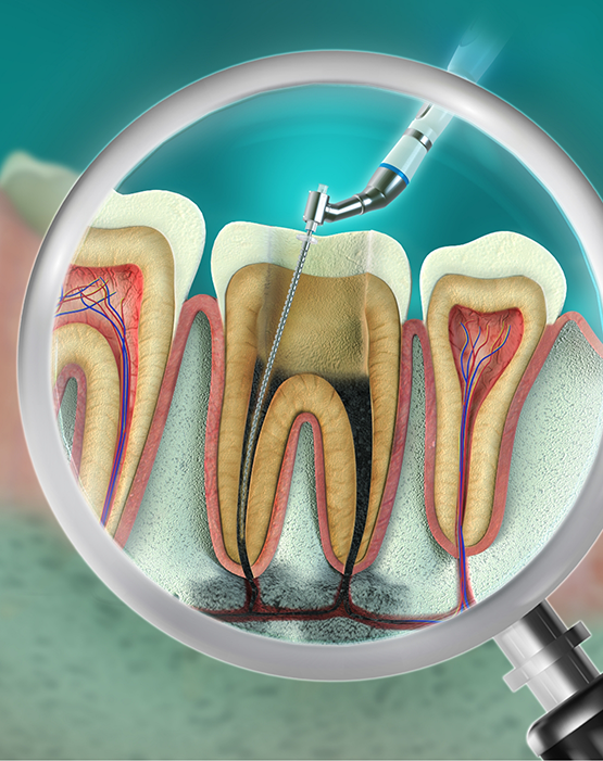 Illustration of root canal treatment being performed