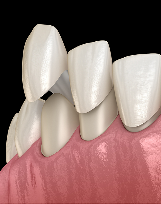 Illustration of veneers being attached to teeth in lower arch