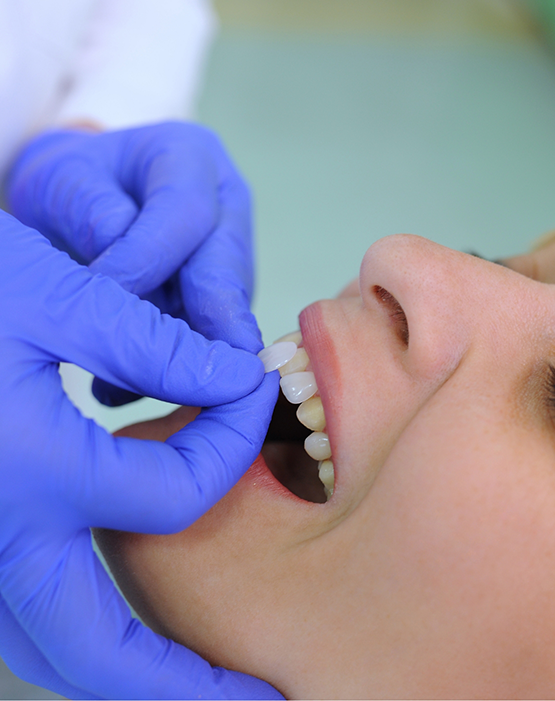 Dentist with gloved hand preparing to place a veneer on a patient's tooth