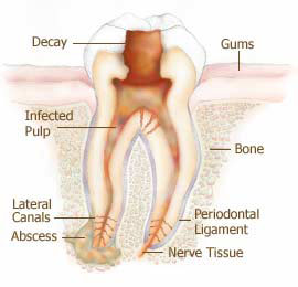 root canal