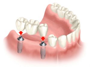 dental implant