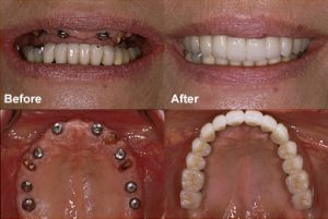 dental implants replacing missing upper teeth to improve function and smile
