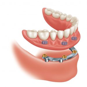 dental implant