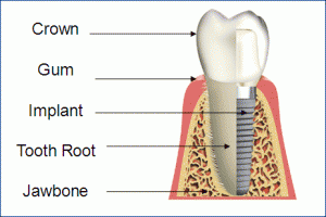 dental implant