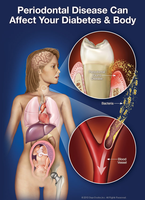 gum disease